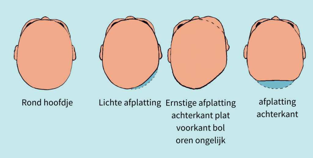 verschillende afplattingen schedel